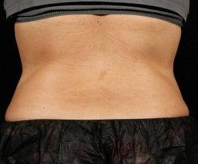 After SculpSure® Female Patient Back Angle View Case 3832