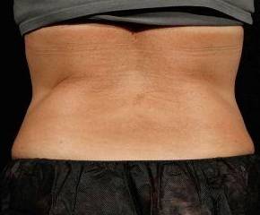Before SculpSure® Female Patient Back Angle View Case 3832