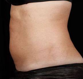 After SculpSure® Female Patient Side Angle View Case 3835