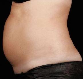 Before SculpSure® Female Patient Side Angle View Case 3835