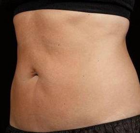 After SculpSure® Female Patient Diagonal Angle View Case 3838
