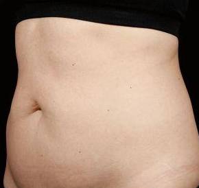 Before SculpSure® Female Patient Diagonal Angle View Case 3838