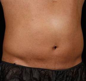 After SculpSure® Male Patient Right Angle View Case 3841