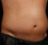 Before SculpSure® Male Patient Right Angle View Case 3841