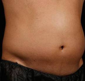 Before SculpSure® Male Patient Right Angle View Case 3841