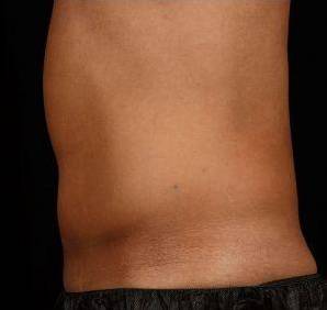 After SculpSure® Male Patient Side Angle View Case 3841