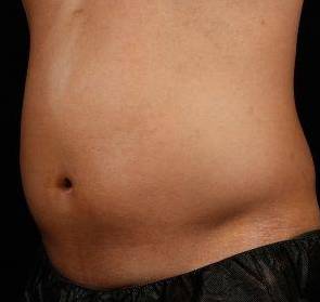 Before SculpSure® Male Patient Left Angle View Case 3841