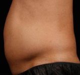 Before SculpSure® Male Patient Side Angle View Case 3841