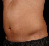 After SculpSure® Male Patient Left Angle View Case 3841