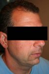 After SmartLipo™ Male Patient Right Angle View Case 3861