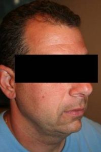 After SmartLipo™ Male Patient Right Angle View Case 3861