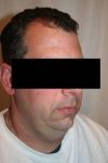 Before SmartLipo™ Male Patient Right Angle View Case 3861