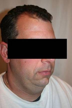 Before SmartLipo™ Male Patient Right Angle View Case 3861