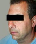 After SmartLipo™ Male Patient Left Angle View Case 3861