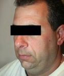 Before SmartLipo™ Male Patient left Angle View Case 3861