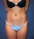 After SmartLipo™ Female Patient Front Angle View Case 3867