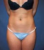 After SmartLipo™ Female Patient Front Angle View Case 3867