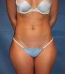Before SmartLipo™ Female Patient Front Angle View Case 3867