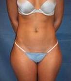 Before SmartLipo™ Female Patient Front Angle View Case 3867