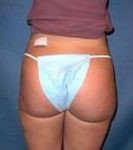 After SmartLipo™ Female Patient Back Angle View Case 3867