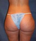 Before SmartLipo™ Female Patient Back Angle View Case 3867