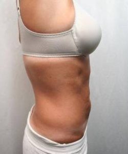 After SmartLipo™ Female Patient Side Angle View Case 3872