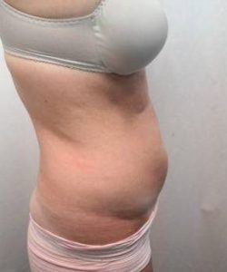 Before SmartLipo™ Female Patient Side Angle View Case 3872