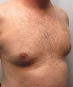 After Liposuction Male Patient Diagonal Angle View Case 3875