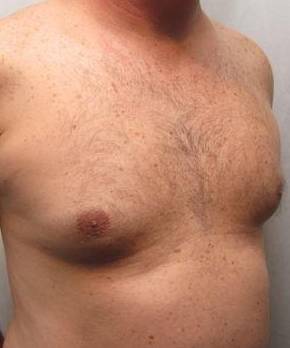 After Liposuction Male Patient Diagonal Angle View Case 3875