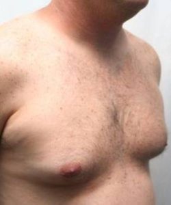 Before Liposuction Male Patient Diagonal Angle View Case 3875