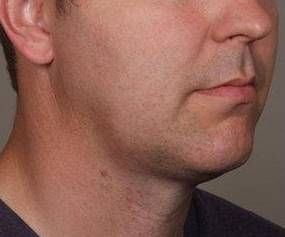 After SmartLipo™ Male Patient Diagonal Angle View Case 3878