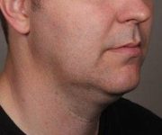 Before SmartLipo™ Male Patient Diagonal Angle View Case 3878