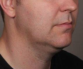Before SmartLipo™ Male Patient Diagonal Angle View Case 3878
