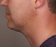 After SmartLipo™ Male Patient Side Angle View Case 3878