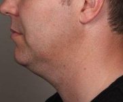 Before SmartLipo™ Male Patient Side Angle View Case 3878