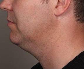 Before SmartLipo™ Male Patient Side Angle View Case 3878