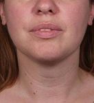 After SmartLipo™ Female Patient Front Angle View Case 3883
