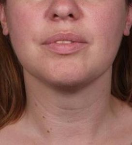 After SmartLipo™ Female Patient Front Angle View Case 3883