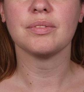 After SmartLipo™ Female Patient Front Angle View Case 3883