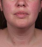 Before SmartLipo™ Female Patient Front Angle View Case 3883