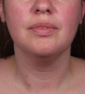 Before SmartLipo™ Female Patient Front Angle View Case 3883