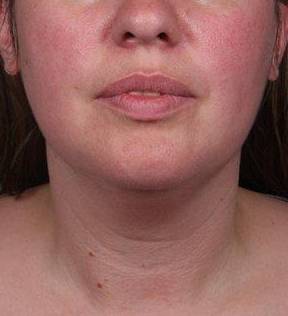 Before SmartLipo™ Female Patient Front Angle View Case 3883
