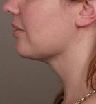 After SmartLipo™ Female Patient Side Angle View Case 3883