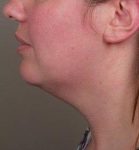 Before SmartLipo™ Female Patient Side Angle View Case 3883