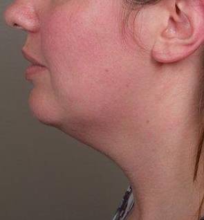 Before SmartLipo™ Female Patient Side Angle View Case 3883