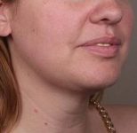 After SmartLipo™ Female Patient Diagonal Angle View Case 3883