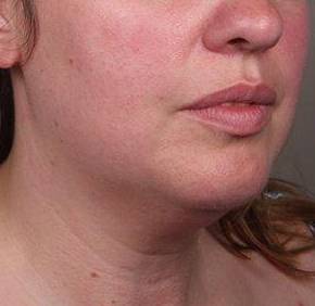 Before SmartLipo™ Female Patient Diagonal Angle View Case 3883