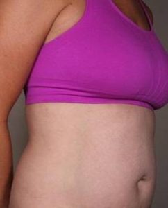 After SmartLipo™ Female Patient Diagonal Angle View Case 3890