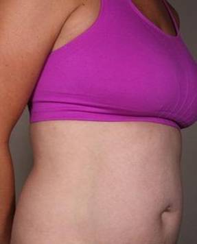 After SmartLipo™ Female Patient Diagonal Angle View Case 3890