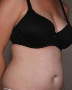 Before SmartLipo™ Female Patient Diagonal Angle View Case 3890